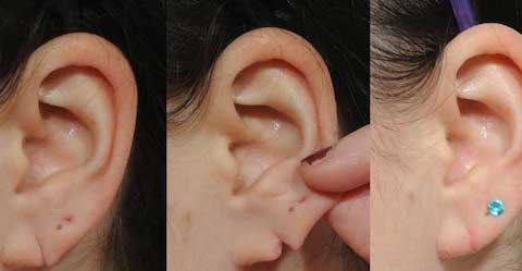 ear lobe repair / lobuloplasty