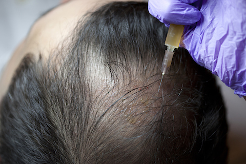 stemcell hair therapy
